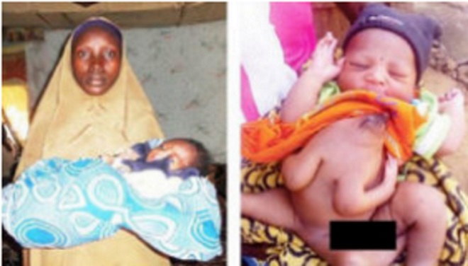 0_1521255092263_baby 4 hands and 3 legs.jpg