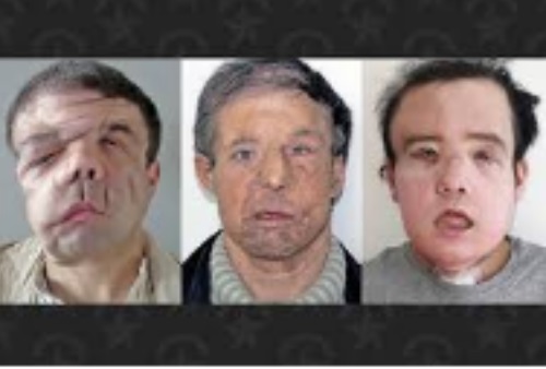 0_1525107274735_French man becomes world's first person to undergo two face transplants.jpg